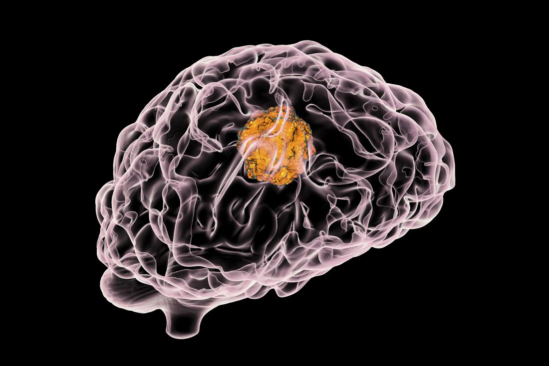 An x-ray image of a brain showing a brain tumor in yellow
