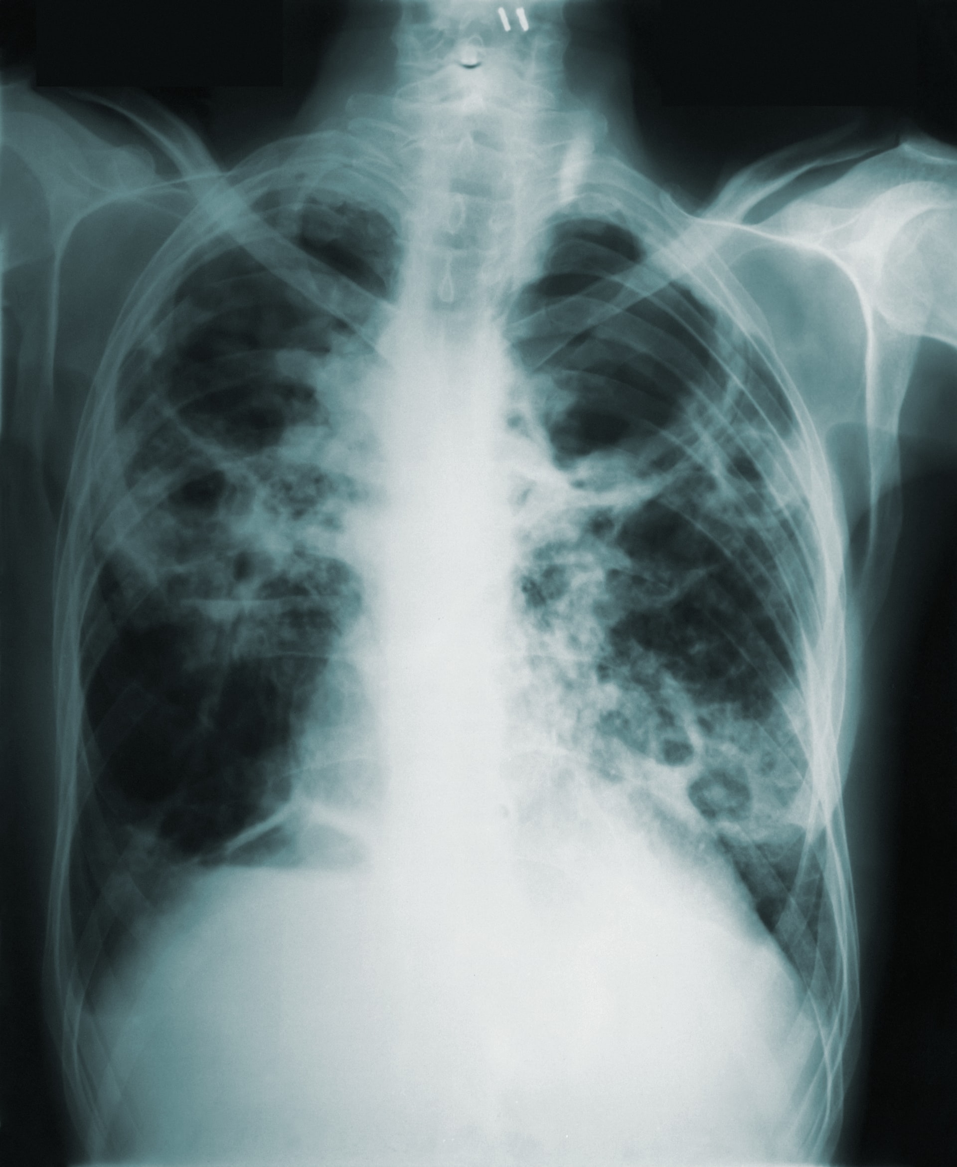 Black and white color x-ray image of the human chest