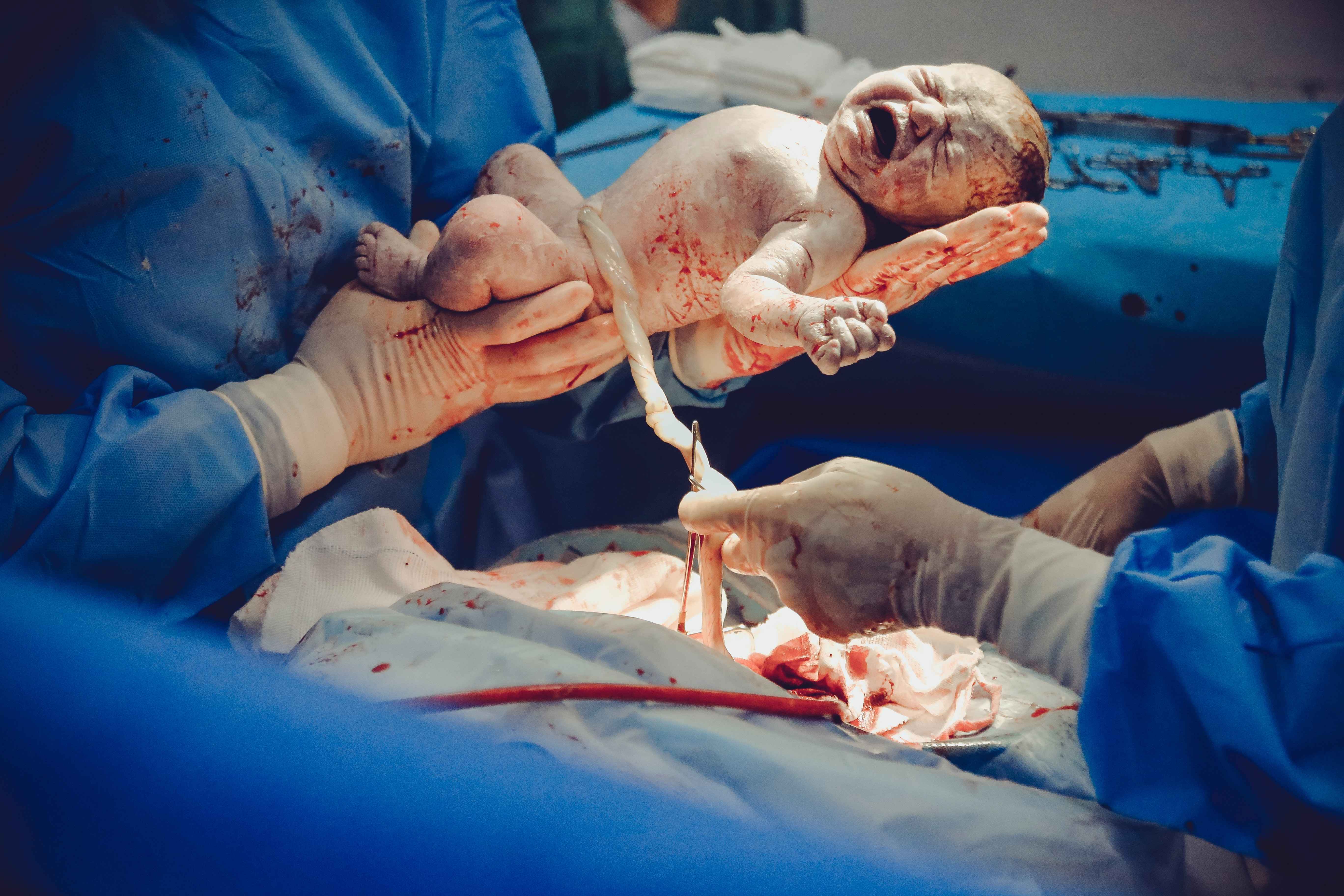 A doctor is holding newborn baby while other doctor is doing surgery during child birth
