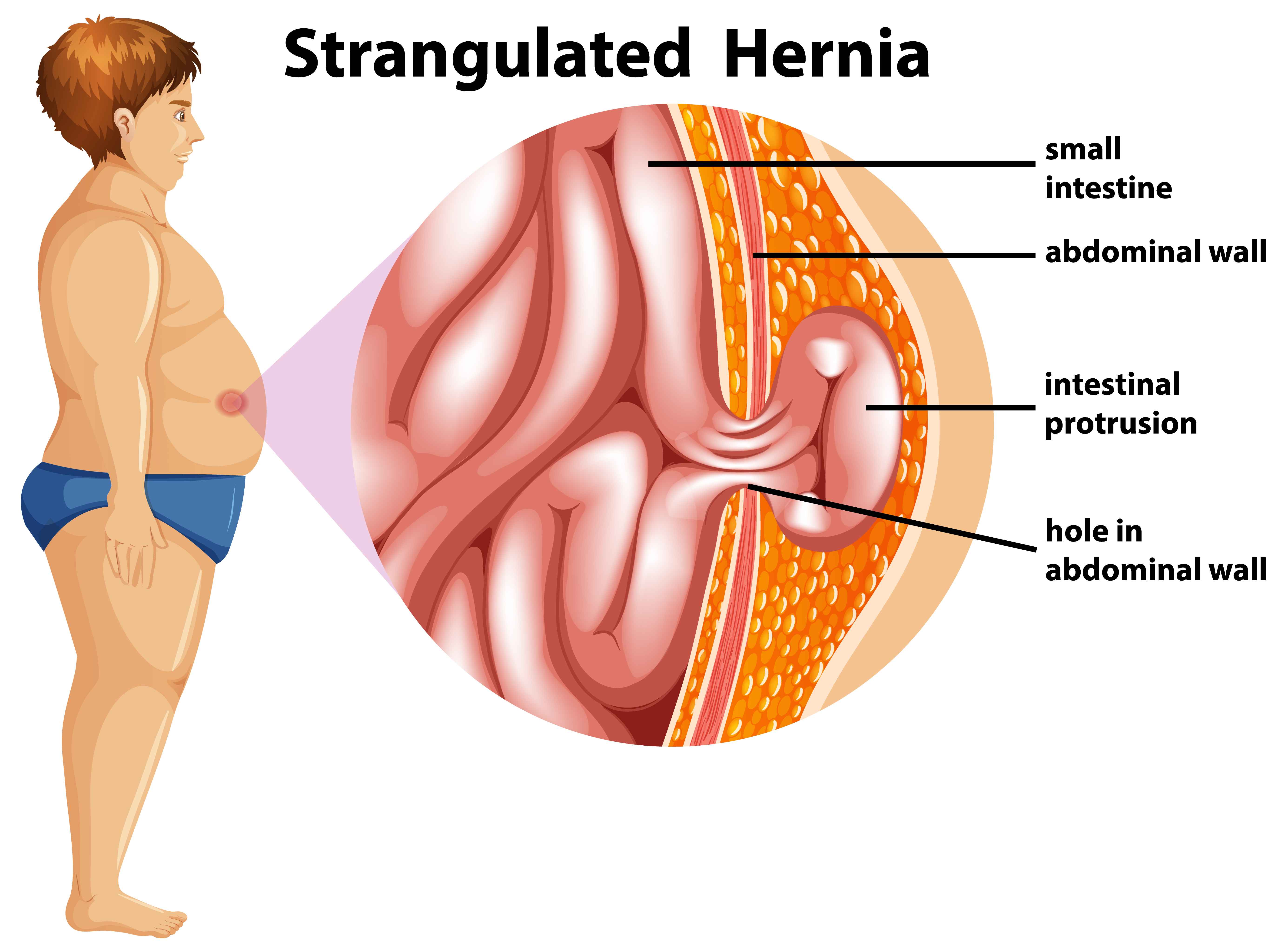 Visual presentation of a person and magnified strangulated hernia