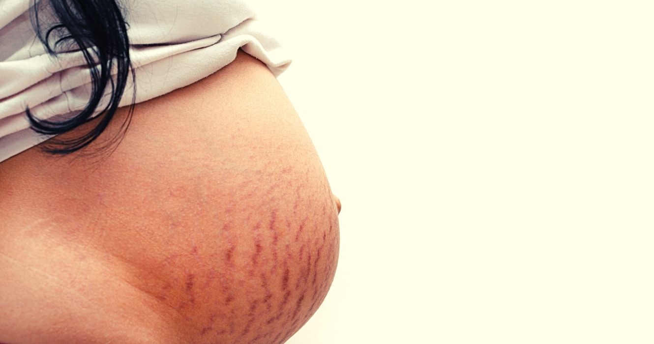 Best Lotion For Stretch Marks – How To Maximize Benefits