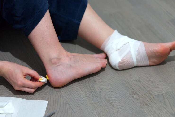 A girl is using ointment and bandage to treat feet