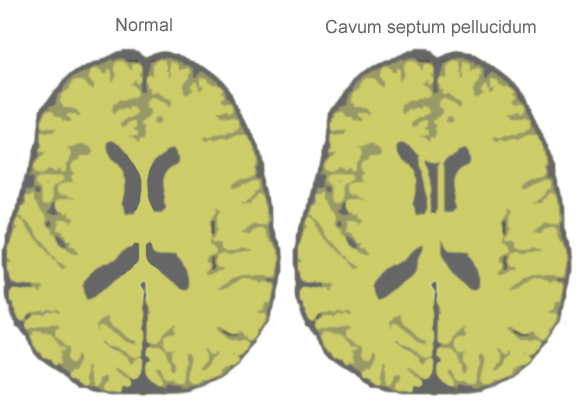Septum Cavum Pellucidum – Prevalence And Risks In Childern